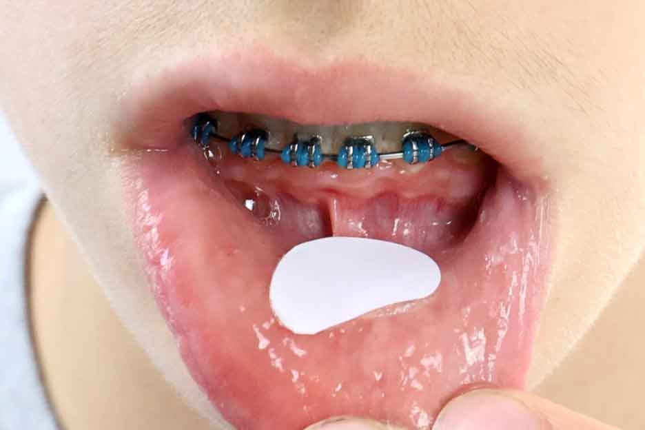 OrthoNu Mouth-Aid